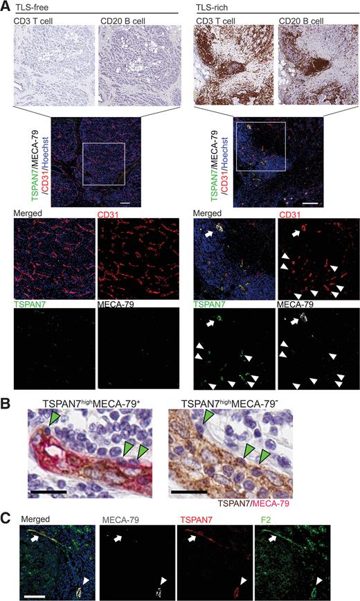 Figure 6. TSPAN7+MECA-79– tumor vessels are associated with lymphocyte clustering and found in TLS. A, IHC staining of different lymphocyte markers was conducted in serial tumor sections to visualize infiltration of T cells, B cells, and Tregs in TLS-free and TLS-rich breast cancer. Tumor specimens of 10 patients were examined for each tumor type (TLS-rich and TLS-free). These tumor specimens were from the same patients assessed in Fig. 1. The consecutive sections of the same tumors were analyzed by immunofluorescence for TSPAN7, MECA-79, and CD31 (lower panels). TSPAN7+MECA-79+ double-positive HEVs (arrows) and TSPAN7+MECA-79– vessels (arrowheads) are both localized in TLS. For the IHC image of the TLS-free tumor, a lower magnification of Fig. 1E is shown. The data shown are for 1 patient representative of each tumor type. Scale bar, 200 µm. B, Immunostaining of MECA-79 (red) and TSPAN7 (brown) in a TLS-rich breast cancer specimen. Leukocytes engrafted in the endothelial wall of TSPAN7highMECA-79+ and TSPAN7highMECA-79– blood vessels are shown. Scale bar, 20 µm. C, Immunostaining of TSPAN7, MECA-79, and sLeX (by F2 antibody) in TLS-rich tumor sections. Arrows show TSPAN7+MECA-79– vessels detected by the F2 antibody. Arrowhead, TSPAN7+MECA-79+ vessels. A representative image of four TLS-rich tumor samples is shown. Scale bar, 100 µm.