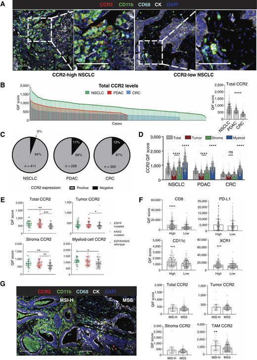 Spatially resolved and quantitative analysis of CCR2 in human NSCLC, PDAC, and CRC. A, Representative multicolor fluorescence micrographs of NSCLC cases with high (left) and low CCR2 protein expression (right). The color code for the markers is indicated within the caption. CCR2 colocalizes with CD11b/CD68 double-positive myeloid cells both within the CK+ tumor epithelium and in the surrounding stroma. Scale bar, 250 µm. B, Expression and distribution of total CCR2 protein levels (all cells) in NSCLC (green bars), PDAC (red bars), and CRC (blue bars). Each column in the histogram indicates the total CCR2 protein level in an individual tumor from the cohort. The chart on the right shows the mean levels of CCR2 protein across the three tumor types. C, Detection of CCR2 positivity in the tumor samples using the visual threshold showed a detectable signal in 94% of NSCLCs (N = 411), 89% of PDACs (N = 228), and 87% of CRCs (N = 350). D, Levels of CCR2 protein measured in the entire tumor tissue sample (total), or selectively in CK+ tumor epithelial cell areas (tumor), in CK− tumor tissue areas (stroma) and in CD11b+ myeloid cells (myeloid) across NSCLC, PDAC, and CRC. E, Levels of CCR2 protein in selected tumor tissue compartments across primary lung adenocarcinomas with activating EGFR (green, n = 26) and KRAS mutations (red, n = 38) and in tumors lacking oncogenic variants in both oncogenes (gray, n = 57). Each dot in the graph represents the score in an individual tumor sample. F, Levels of CD8, PD-L1, CD11c, or XCR1 protein in primary NSCLCs with low or high CCR2 protein levels. Cases were stratified into high/low groups using the median total CCR2 protein scores. G, Representative multicolor fluorescence micrographs of CCR2, tumor, and myeloid cells in CRC cases with microsatellite instability–high (MSI-H; left) and microsatellite stable (MSS) status (right). The color code for the markers is indicated within the caption. The charts on the right show the CCR2 protein levels across the MSI-H (n = 51) and MSS (n = 282) CRC subgroups in the entire tissue area (total) or selectively measured in CK+ epithelial tumor cells (tumor), CK− stromal cells (stromal), or in CD68+ TAMs. *, P < 0.05; **, P < 0.01; ***, P < 0.001; ****, P < 0.0001; ns, not significant with P > 0.05. QIF, quantitative immunofluorescence.