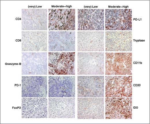 Figure 1. Immunohistochemistry of T-cell inhibitory factors and suppressive cells in melanoma tissues. (Very) low to moderate–high numbers of T cells, including CD4+, CD8+, PD-1+ T cells, FoxP3+ regulatory T-cells, and cytotoxic marker granzyme-B (left), and the presence of suppressive cells such as PD-L1+ cells, tryptase+ mast cells, CD11b+CD33+ MDSCs, IDO+ cells (right) in melanoma tissues. The percentages of these infiltrating cells, designated as (very) low, ranged between 0.5% and 40%, whereas moderate to high ranged between 40% and 100%. Because of the overall low expression of PD-1, FoxP3, and tryptase in the tumor, both images shown represent (very) low. Original magnification, ×400.