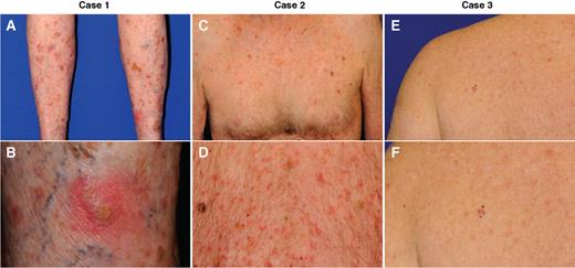 Lichenoid Dermatitis in Three Patients with Metastatic Melanoma Treated ...