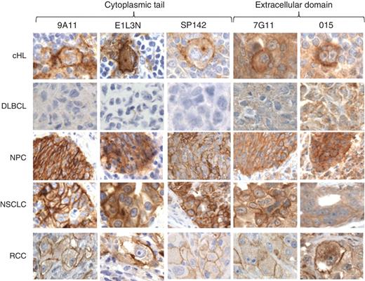 Figure 4. Comparison of PD-L1 mAbs in IHC across multiple tumor types. Representative photomicrographs of select tumors stained with PD-L1 antibodies, 9A11, 7G11, E1L3N, 015, and SP142 (brown coloration) in cHL, DLBCL, NPC, NSCLC (a representative adenocarcinoma), and RCC, as indicated. Representative of 50 to 300 cases for 9A11, 7G11, E1L3N, and 015, and 11 cases for SP142.