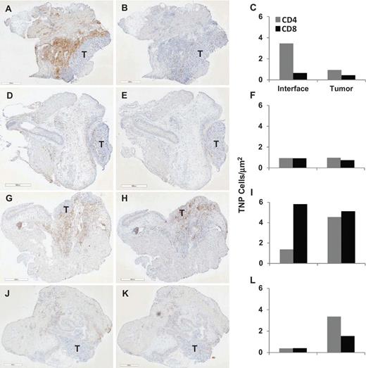 Figure 4. Immunohistochemical detection of CD4 and CD8 immune cell subsets in the bladders of mice treated with avelumab, BCG, or avelumab plus BCG. C57BL/6 mice (n = 10) bearing orthotopic MB49luc tumors were treated with DPBS/saline, DPBS/BCG (1.0 mg), avelumab (3 × 400 μg)/saline, or avelumab/BCG, as described in Fig. 3. Mice were euthanized on day 29, and individual bladders from DPBS/saline (A, B), DPBS/BCG (D, E), avelumab/saline (G, H), and avelumab/BCG (J, K) were stained for CD4 (A, D, G, J) and CD8 (B, E, H, K) T cells as described in Materials and Methods. Bar = 600 μm. Plots C, F, I, and L represent the number of CD4 and CD8 T cells enumerated at the bladder/tumor interface and within the tumor mass as described in Materials and Methods. Data are from a representative experiment that was repeated with similar results. T, tumor.