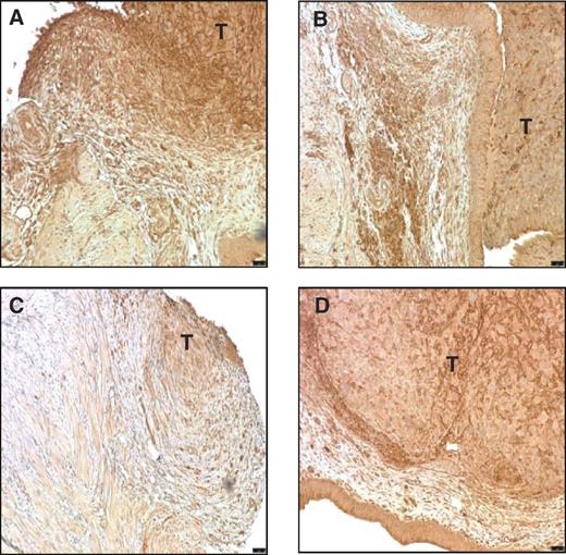 Figure 5. Immunohistochemical detection of PD-L1 in the bladders of mice bearing tumors and treated with PBS (A), BCG (B), avelumab (C), or avelumab plus BCG (D). Bar = 50 μm, magnification, ×100. T, tumor.