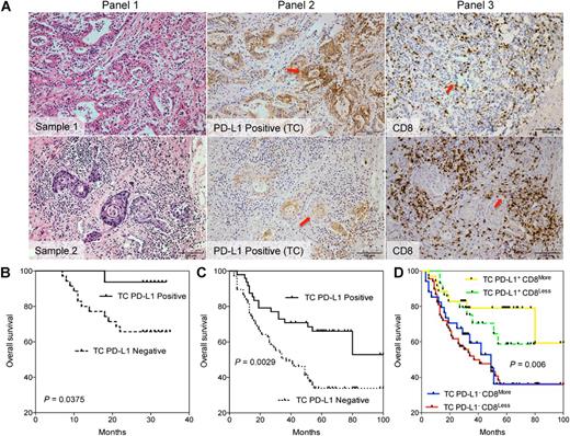 Figure 5. Expression of PD-L1 by tumor cells and its correlation with CD8 expression. A, H&E staining (panel 1), and representative images of positive PD-L1 expression (panel 2) in tumor cells surrounded by tumor-infiltrating CD8+ T cells (panel 3), at × 200 (100 μm) original magnification. B, OS of patients grouped by positive or negative expression by tumor cells of PD-L1 in the discovery cohort and C, in the validation cohort. D, OS of patients grouped by the combination of tumor cell positive or negative expression PD-L1 and “more” or “less” percentages of infiltrating CD8+ T cells, in all 166 gastric cancer patients: TC PD-L1+ CD8More vs. TC PD-L1+ CD8Less, P = 0.317; TC PD-L1+ CD8More vs.TC PD-L1− CD8More, P = 0.02; TC PD-L1+ CD8More vs. TC PD-L1− CD8Less, P = 0.002; TC PD-L1+ CD8Less vs. TC PD-L1− CD8More, P = 0.104; TC PD-L1+ CD8Less vs. TC PD-L1− CD8Less, P = 0.031; TC PD-L1− CD8More vs. TC PD-L1− CD8Less, P = 0.681. Probabilities of OS were estimated using the Kaplan–Meier method and compared using the log-rank statistics.
