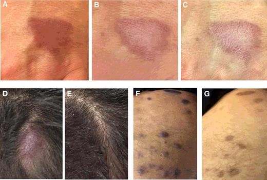 Figure 1. Baseline and posttherapy lesion photographs. A–C, Case example (patient 2). Left-hand lesion (A) pretherapy, (B) post 4 weeks, and (C) post 8 weeks of therapy. D–G, Case example (patient 9). Scalp lesion (D) pretherapy and (E) post 6 weeks of therapy. Right medial thigh lesion (F) pretherapy and (G) post 6 weeks of therapy.
