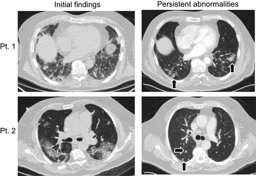 Figure 2. Representative cross-sectional lung CT imaging of initial pneumonitis radiographic findings, and persistent scarring following >6 months after initial findings (patient 1) and nodularity (patient 2) denoted by black arrows. Representative of the 31 patients.