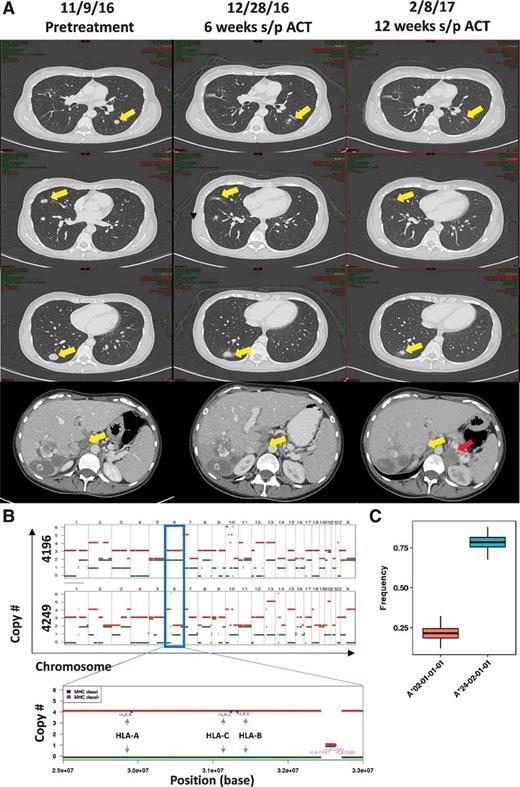 Figure 2. Treatment of a patient with metastatic colon cancer with TILs. A, Serial cross-sectional imaging indicating initial regression in the patient's target lesions (lungs, top three panels; aortocaval lymph node, bottom) and evolution of a new left adrenal mass by 12 weeks after ACT (bottom, red arrow). B, Chromosome copy-number analysis comparing the pulmonary lesions (4196) with the adrenal tumor (4249). Red and green bars represent the relative numbers of homologs for each chromosome with relative height on the chart indicating the number of copies for that homolog (top two panels). The HLA locus is located on chromosome 6 (blue outlined box). A magnified view of the earlier portion of chromosome 6 is shown (bottom). Here, the relative locations of HLA-A, HLA-B, and HLA-C alleles are indicated (blue arrows), suggesting that LOH had contributed to the loss of a complete set of class I alleles. C, HLA allele reads were used to estimate the relative frequency of each HLA allele in 4249 (the subsequently resected adrenal lesion). A*0201 is denoted in the red box plot, whereas A*2402 is denoted in the blue box plot. Normal anticipated frequency would be 0.50.