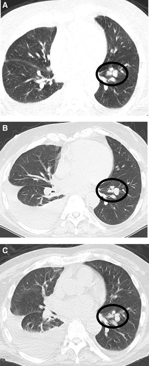 Figure 3. Computerized tomography scan showing a 1.4-cm nodule reappeared 16 weeks after steroids were initiated and pembrolizumab was discontinued (A). B, After two doses of secukinumab and pembrolizumab still not reinitiated, nodule remains stable. C, Eleven weeks after secukinumab treatment was stopped and 28 weeks after pembrolizumab was stopped, the nodule remained stable.