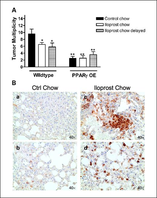 Fig. 4. Mice fed iloprost and PPARγ OE transgenic mice develop fewer lung tumors than WT controls. A, WT or PPARγ OE mice were injected with ethyl carbamate at 1 mg/g of mouse weight. Twenty weeks later, mice were sacrificed and lung tumors counted. Black columns, mice fed control chow; white columns, mice fed chow containing 3% iloprost from 1 wk before injection through the end of the study; hatched columns, mice fed control chow until 5 wk after the injection and then changed to chow containing 3% iloprost for the remainder of the study. *, P < 0.05, versus WT mice fed control chow; **, P < 0.001, versus WT mice fed control chow. The difference between WT mice fed iloprost chow and PPARγ mice fed control chow or iloprost chow was also significant (P < 0.05). B, increased accumulation of macrophages in lungs of iloprost fed mice. WT mice were injected with ethyl carbamate at 1 mg/g of weight. Mice were fed control chow or chow containing 3% iloprost 1 wk before injection through the end of the study. Representative lung tissues from control-fed mice (a and b) compared with iloprost-fed mice (c and d) immunohistochemically stained for the macrophage marker F4/80 (brown reaction color).