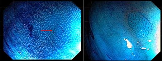 Figure 2. Rectal ACF consist of clusters of abnormal appearing and enlarged colonic crypts that can be visualized at chromoendoscopy.
