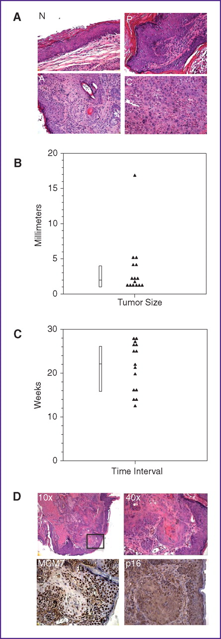 Figure 3. Histopathology of anal tissue. A, H&E-stained sections of various samples categorized as normal (N) including inflammation and hyperkeratosis, hyperplasia, papilloma (P), atypia (A), and carcinoma (C). B, frequency of overt tumors. Note that overt tumors appeared at the highest frequency in the E6/E7 mice treated with 0.12 μmol DMBA. Tumors were a median of 2 mm in size at the time of sacrifice with a range from 1 to 17 mm. The largest tumor occurred when 3 smaller tumors coalesced followed by aggressive growth; as such this mouse was euthanized 4 days prior to the original endpoint. C, time of onset of tumors. Note that overt tumors arose at a median of 22 weeks after 0.12 μmol DMBA treatment was initiated with a range from 11 to 27 weeks. D, expression of cancer biomarkers in mouse. Tissue sections from mouse anal cancer are shown. Top, H&E stained sections showing keratin pearls and large atypical nuclei consistent with squamous cell carcinoma. Bottom, representative images of a cancer stained with MCM7 (left bottom) and p16 (right bottom). See Supplementary Table S1 for a complete reporting of the IHC for all samples evaluated.