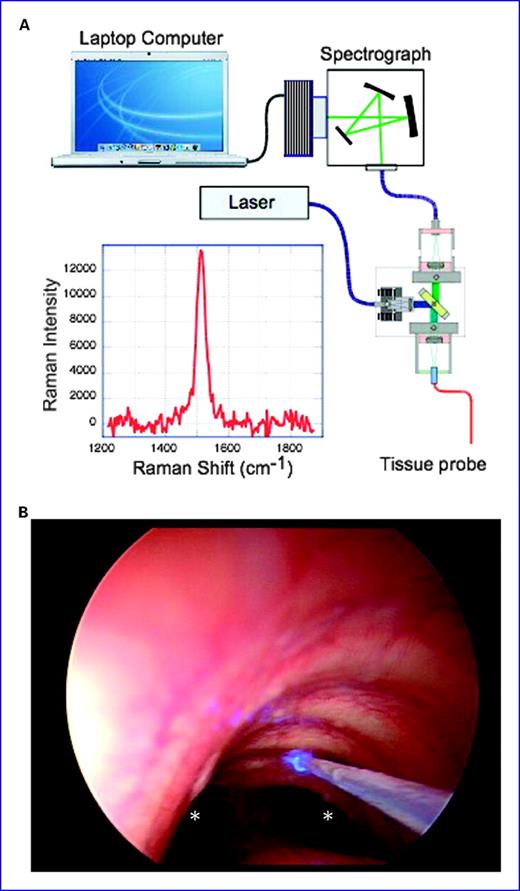 Fig. 2. Single-fiber resonance-enhanced Raman spectroscope. A, light from an argon laser is routed into an optical module where a specially designed holographic optical element couples the laser light (∼1 mW) into an endoscope-compatible single optical fiber probe. The probe is momentarily (∼12 s) held in contact with tissue during a measurement. Laser light illuminates the tissue, and back-scattered light is collected by the probe and routed back to the optical module where the holographic optical element selectively accepts the Raman-shifted wavelength of light and routes this light into another fiber optic cable connected to a compact high-throughput spectrograph equipped with a high dynamic range charge-coupled device detector interfaced with a laptop computer running software designed specifically for making quantitative in vivo Raman measurements. The isolated 1,525 cm−1 carotenoid peak from a volunteer's soft palate is characterized using a Lorentzian line shape and has been found to be linearly proportional to the tissue carotenoid concentrations in live tissue (14, 15). B, Fiberoptic probe measuring tracheal mucosa shows the ready use for measuring any tissue that is endoscopically accessible. A 600-μm fiberoptic probe was inserted through a ventilating bronchoscope. The probe was brought into contact with the tracheal mucosa just superior to the carina and mainstem bronchi (*). The mucosa was illuminated with the blue/green laser light and Raman measurements were made through the same fiberoptic probe.