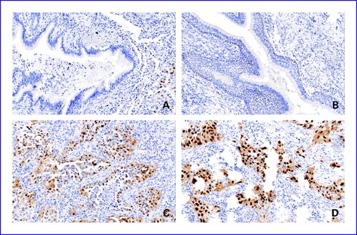Fig. 1. Immunohistochemical localization of cyclin D1 in normal bronchial epithelium, placebo group (A); normal bronchial epithelium, β-carotene group (B); lung tumor cells, placebo group (C); and lung tumor cells, β-carotene group (D). In A, a bronchial lumen filled with mucus and lined by tall columnar ciliated epithelium is shown. Cyclin D1 immunoreactivity is essentially absent, with the exception of rare scattered nuclei. In B, numerous positive-staining nuclei within the basal layer and in regions of pseudo-stratification of the columnar ciliated bronchiolar-type epithelium are shown. In C and D, tumor cells show frequent strong nuclear positivity for cyclin D1 along with some diffuse cytoplasmic staining. In contrast, stromal cells and chronic inflammatory cells show rare cyclin D1 staining. All photomicrographs are at ×20 magnification.