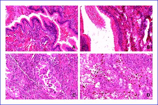 Fig. 2. Immunohistochemical localization of Ki67 in normal bronchial epithelium, placebo group (A); normal bronchial epithelium, β-carotene group (B); lung tumor cells, placebo group (C); and lung tumor cells, β-carotene group (D). In A and B, nuclear positivity for Ki67 is essentially absent in columnar ciliated bronchiolar-type epithelium. In C, only scattered malignant cells show nuclear staining for Ki67, whereas numerous positive-staining nuclei are apparent in D. Rare scattered inflammatory cells are also positive for Ki67 in D. All photomicrographs are at ×20 magnification.