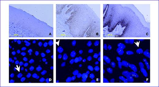 Fig. 1. EGFR protein expression and gene copy number in oral leukoplakia (OPL). OPL with EGFR expression scored 1+ (A), 2+ (B), and 3+ (C). Of the 49 patients considered for EGFR gene copy number, disomy (two, indicated by an arrow, or fewer copies in >90% of cells) was observed in 29 (59%) OPLs (D), low trisomy (three copies, indicated by an arrow, in 10-40% of cells) in 14 (29%) OPLs (E), high trisomy (≥40% of cells with three copies and <10% of cells with four copies, indicated by an arrow) in one (2%) case, low polysomy (10-40% of cells with four copies) in 4 (8%) OPLs (F), and gene amplification (clustered unbalanced gain of EGFR) in one (2%) case.