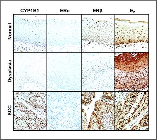 Figure 5. Representative images of human head and neck tissues from TMAs stained with antibodies against CYP1B1, ERα, ERβ, and E2. Secondary antibody alone was used as a negative control (not shown). Magnification 20×.