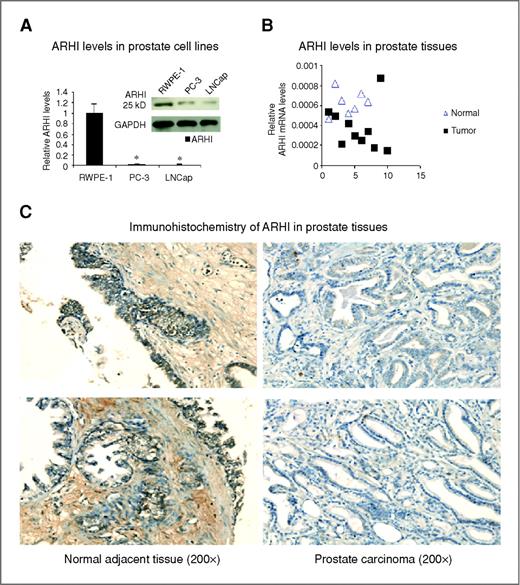 Figure 1. ARHI is downregulated in prostate cancer. A, ARHI mRNA and protein levels in immortalized RWPE-1 prostate cells, and prostate cancer PC-3 and LNCap cells by real-time PCR and Western blot. Data were normalized to GAPDH signal. *, P < 0.05. B, ARHI mRNA level in 7 adjacent normal prostate tissues and 10 prostate tumor tissues by Q-PCR plates. Data were normalized to GAPDH signal. C, immunohistochemical staining of ARHI in prostate tissues. A prostate tissue microarray was immunostained with ARHI antibody to examine ARHI in matched adjacent prostate normal tissues and carcinoma tissues. Left, ARHI staining in adjacent normal tissues. Right, matched carcinoma tissues (×200).