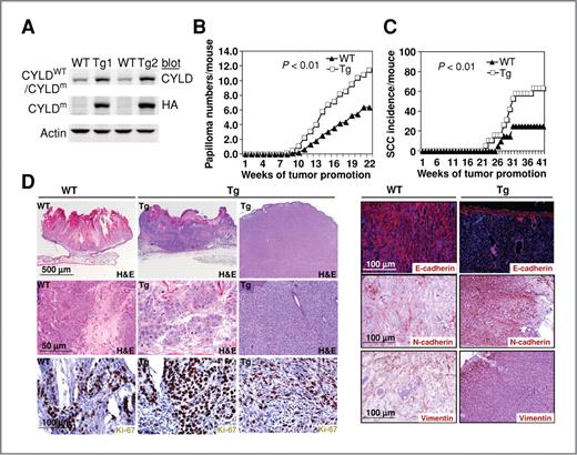 Figure 1. K14-CYLDm transgenic mice display increased tumor growth and malignant progression. A, immunoblotting of mouse epidermal cell lysates from wild-type (WT) or transgenic (Tg) mice with antibodies against CYLD, HA, and actin. B, average number of tumors per mouse. C, incidence of malignant progression to SCC. WT and Tg siblings (n = 20 and 21) were subject to the DMBA/TPA 2-stage carcinogenesis protocol. Tumor numbers and signs of SCC were scored weekly. Statistical P values were shown inside the graphs. D, histologic analysis of tumors from WT and Tg mice by hematoxylin and eosin (H&E) staining and immunostaining for Ki-67, E-cadherin (orange), N-cadherin or vimentin (brown). Nuclei (blue, Hoechst, or hematoxylin).