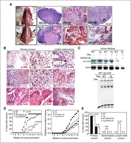 Figure 2. Tumors developed on K14-CYLDm transgenic mice metastasize to lymph node in a JNK/AP1-dependent manner. A, inguinal lymph nodes of WT (WT/LN) and Tg (Tg/LN) mice were collected at 32 weeks following DMBA/TPA challenge. Clinical images of representative lymph nodes were shown along with histologic analysis by H&E staining or immunostaining for cytokeratin 5 (K5) and Ki-67 (brown). Nuclei (blue). B, immunostaining of the primary skin tumors and the lymph node tumors with antibodies against p-JNK, c-Fos, and RelA (brown). Nuclei (blue). C, mouse keratinocytes isolated from WT and Tg mice were treated with or without 100 nmol/L TPA and 10 μmol/L SP600125 and then collected for immunoblotting for p-c-Jun and Actin and for AP1-gel mobility shift assay. D, WT and Tg siblings (n = 15–20) were subject to DMBA/TPA carcinogenesis either with or without topical SP600125 prior to each TPA application. The percentage of mice which developed at least 1 tumor and the average papilloma numbers per mouse were shown in the graph in a weekly time-course manner. E, percentage of mice developed primary, sarcomatoid, and lymph node tumors. The denominators and numerators above each column represent the total number of mice initiated for the study and the number of mice that developed indicated tumors, respectively.