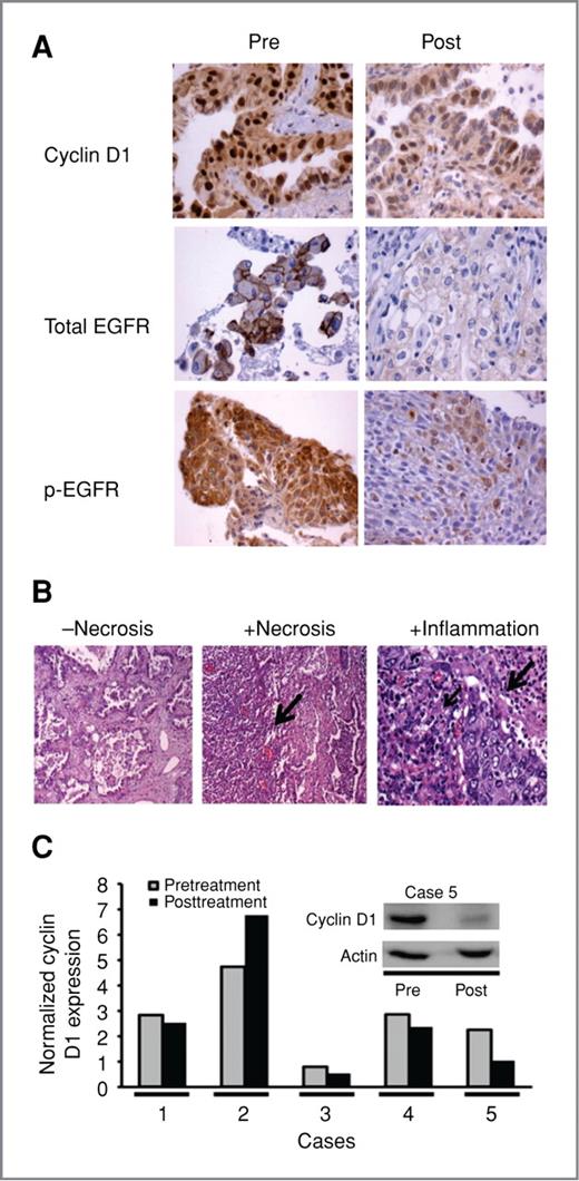 Figure 2. Biomarker, histopathologic, and buccal swab treatment effects in the window-of-opportunity trial combining bexarotene with erlotinib. A, reduced immunohistochemical expression of cyclin D1 (patient 5), total EGFR (patient 9), and p-EGFR (patient 1) in posttreatment “Post” versus pretreatment “Pre” lung cancer biopsies (200×). B, no evidence of necrosis (−Necrosis; left), presence of necrosis (+Necrosis, arrow; middle), and inflammatory response (+Inflammation; small arrow shows chronic inflammatory infiltrate and large arrow shows acute inflammatory infiltrate surrounding a lung cancer; right) in representative posttreatment lung cancer biopsies (200×). C, cyclin D1 immunoblot expression in pretreatment versus posttreatment buccal mucosal swabs. Normalized cyclin D1 protein signals (relative to actin expression) declined in the majority of the displayed posttreatment versus pretreatment buccal mucosal swabs. The cyclin D1 immunoblot is shown for a representative case (case 5) relative to actin expression as a loading and protein integrity control.