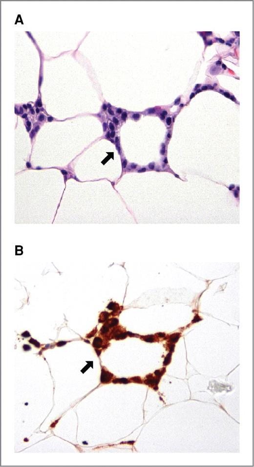 Figure 1. CLS-B occurs in humans. A, H&E-stained slide showing an inflammatory focus containing macrophages that surround an adipocyte (200×). B, immunohistochemical staining with CD68 of same lesion taken approximately 30 μm from section shown in A confirms that the cells constituting CLS-B are macrophages (200×). In A and B, arrows indicate CLS-B.