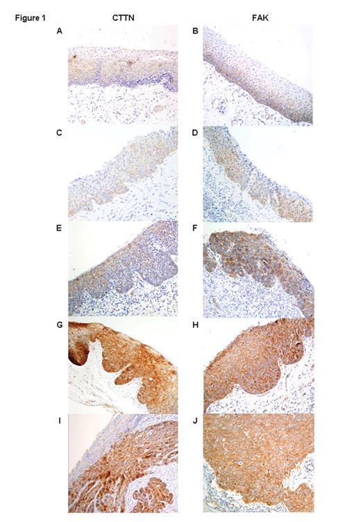 Figure 1. Immunohistochemical analysis of CTTN and FAK expression in laryngeal dysplasias. Normal adjacent epithelia showed negative staining (A and B). Representative examples of laryngeal dysplasias showing weak (C and D), moderate (E and F), and strong positive staining (G and H) and invasive tumors with strong protein expression (I and J). Original magnification ×200.