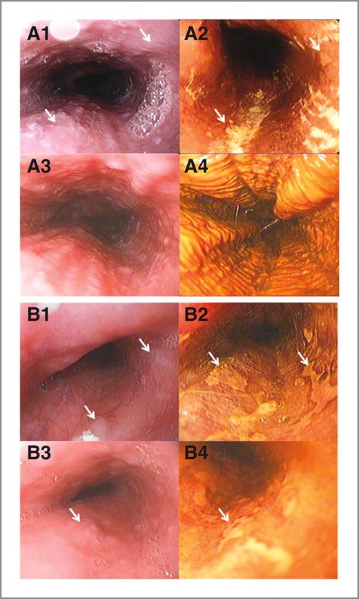 Figure 3. Representative endoscopic images of esophagus before (A1, 2 and B1, 2) and after (A3, 4 and B3, 4) strawberry treatment. A1, 3 and B1, 3, endoscopic images of esophagus before iodine staining. A flat lesion with white patch (white arrows indicated) can be seen in A1, B1, and B3, although it is not clear. A2, B2, and B4, endoscopic images of the same lesion after iodine staining (white arrows indicated). Well-demarcated unstained mucosal areas are clearly observed. The histopathology reports showed that patient A had mild dysplasia (A1 and 2) before strawberry treatment and these lesions regressed to normal esophagus (A3 and 4) after strawberry treatment. Normal mucosa is smooth or mildly wrinkled and shows a diffuse change to brown with iodine staining (A3 and 4). Patient B had moderate dysplasia (B1 and 2) before treatment and mild dysplasia (B3 and 4) after treatment.