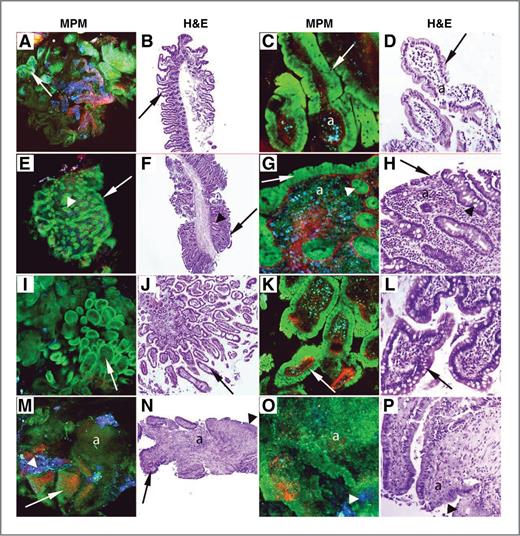 Figure 4. Imaging of small intestinal lesions from human subjects by MPM and H&E. A and B, images of the normal duodenum from a control subject show villi (arrows) lining the mucosal surface at low magnification. C and D, high magnification images of panels A and B show enterocytes (green in MPM) and scattered goblet cells (arrows) lining the villi. The core of the villus (a) shows mononuclear cells (mixture of blue and green cells in MPM), recognized mainly as lymphocytes by H&E. E and F, duodenal biopsy from a subject clinically diagnosed with celiac sprue shows flattened mucosal surface with villus shortening (arrows) and preserved crypts (arrowheads). G and H, high magnification images of panels E and F show the flattened mucosal surface lined by simple columnar cells (arrows) and crypts with goblet cells (arrowheads). The lamina propria (a) has increased inflammatory cell infiltrate (mixture of blue and green cells in MPM), mainly identified as lymphocytes, plasma cells, and eosinophils by H&E. I–L, the normal terminal ileum from a control subject shows villi (arrows) at low (I and J) and high (K and L) magnifications. M–P, ileal biopsy from a subject with Crohn's disease shows morphologic features of chronic active ileitis. Low-magnification images (M and N) show blunted villi (arrows), focal ulcerations (arrowheads), and inflammatory infiltrate (a). High-magnification images (O and P) show focal ulcerations (arrowheads) and inflammatory infiltrate (a; identified as neutrophils and lymphocytes by H&E). MPM total magnifications: A, E, I, M = 48×; C, G, K, O = 300×. H&E total magnifications: B, F, J, N = 40×; D, H, L, P = 200×.