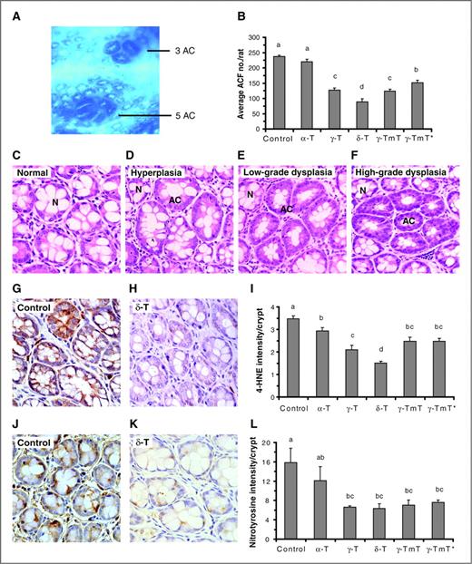 Figure 2. Histologic characterization of ACF, and the effects of tocopherol treatment on ACF formation, 4-HNE levels, and nitrotyrosine levels in the colon. A, AOM-induced colorectal ACF stained with 0.2% methylene blue. B, effects of tocopherol treatments (0.2% in the diet) on ACF formation, shown as mean of ACF numbers/rat ± SE (n = 10). Examples of histologic diagram shown are normal crypts (C); an ACF with hyperplasia (D); an ACF with low-grade dysplasia (E); an ACF with high-grade dysplasia (F). G–L, effects of dietary tocopherols on the levels of 4-HNE (G–I) and nitrotyrosine (J–L). Examples of 4-HNE membrane and cytosolic staining (brown colored) and nitrotyrosine cytosol staining (brown colored) in the colon crypts of the positive control group (G and J), and in the colon crypts of the 0.2% δ-T group (H and K), are shown. I and L, effects of different tocopherol treatments (0.2% in the diet) on the levels of 4-HNE (I) and nitrotyrosine (L), are shown as mean of intensity/crypt ± SE (n = 5). ANOVA-Duncan post hoc test was conducted. Different letters designate significant difference (P < 0.05). γ-TmT*, rats switched to 0.2% γ-TmT diet 1 day after the second AOM treatment. N, normal crypt.