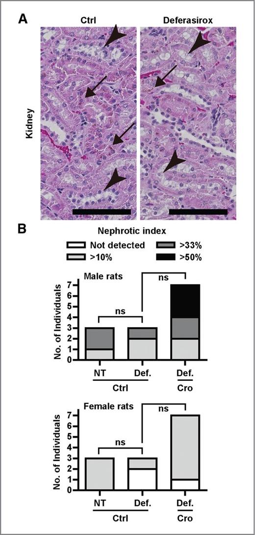 Figure 4. Lack of significant renal damage after long-term deferasirox treatment. A, histologic analysis of kidney after long-term after deferasirox treatment. The presence of slight tubular degeneration (arrowheads) and lipofuscin deposition (arrows) in both control and deferasirox-treated rats. Scale bars, 100 μm. B, the area of degenerative lesions of renal tubules is indicated as a nephrotic index. Statistics was calculated between low degeneration group (“not detected” and “>10%” groups) and high degeneration group (“>33%” and “>50%” groups) to let the χ2 test valid. Scale bars, 100 μm. P values (ns, not significant) were determined by the χ2 test.