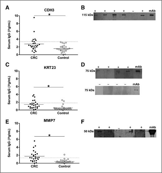 Figure 4. CDH3, KRT23, and MMP7 are immunogenic in patients with early stage CRC. Serum IgG was quantitated with indirect ELISA in 25 early stage CRC (stages 1 and 2) patients and 25 controls. The dotted line represents the cut-off or serum value of the mean plus 2 SD of controls for each protein. Closed circles represent CRC patient sera, open circles represent control sera, and horizontal bars represent mean serum values. Calculated P-values are for differences in mean serum responses, *P < 0.05. Positive (+) and negative (−) antibody responses were validated with protein expression for CDH3 (B), KRT23 (D), and MMP7 (F). Positive controls were recombinant protein blotted with the monoclonal antibody (mAb) for the respective protein.