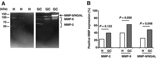 Figure 2. Substrate gel electrophoresis. A, urinary MMP activity in gastric cancer. Representative zymograms of urine sample from healthy control and patients with gastric cancer. Gelatinase activity at approximately 125 kDa corresponds to MMP-9/NGAL complex, at approximately 92 and 80 kDa to MMP-9, and at approximately 72 and 65 kDa to MMP-2. B, positive MMP expression. Urine of patients with gastric cancer contains significantly higher levels of MMP-9/NGAL complex compared with control samples; H, healthy control; GC, gastric cancer.