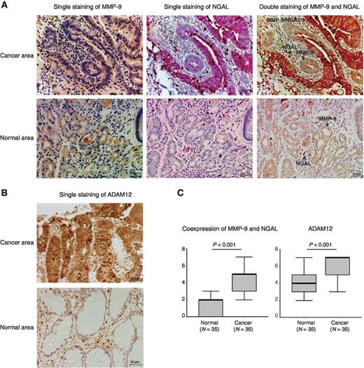 Figure 3. Immunohistochemical analyses of MMP-9, NGAL, and ADAM12. A, representative immunohistochemical images of MMP-9 and NGAL. These images are a representative case of single and double staining for MMP-9 and NGAL in cancer and adjacent normal tissues of early gastric cancer (stage IA). The quantity of uMMP-9/NGAL in this case was 1225 pg/mL. With MMP-9 stained brown and NGAL stained red, MMP-9/NGAL complex was recognized as colocalization of MMP-9 (brown) and NGAL (red). MMP-9 (brown) was positive in cancer epithelial cells, whereas NGAL (red) was positive in most of tumor epithelial cells and some stromal cells. Colocalization of MMP-9 and NGAL was observed in most of the tumor epithelial cells. MMP-9 (brown) was weakly detected in some normal epithelial cells, whereas NGAL (red) was detected in a small number of normal stromal cells. No colocalization of MMP-9 and NGAL was observed in the normal tissue. B, representative immunohistochemical images of ADAM12. These images are a representative case of ADAM12 staining in cancer and adjacent normal tissues of early gastric cancer (stage IA). The quantity of uADAM12 in this case was 3.81 ng/mL. ADAM12 (brown) diffusely and strongly expressed in cancer tissues, whereas weak to moderate immunoreactivity to ADAM12 was detected in normal stromal tissues. C, quantitative analysis of immunohistochemistry. Staining scores were calculated in cancer and adjacent normal tissues of all gastric cancers. Data were analyzed using the Mann–Whitney U test.
