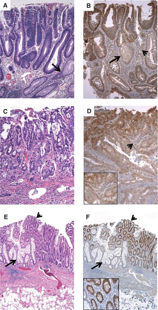 Figure 1. Id1 is expressed in human colorectal neoplasia. A, sporadic colonic adenomas contain straight tubules lined by dysplastic epithelial cells with cigar-shaped nuclei (top) compared with normal entrapped crypts (arrow) with abundant cytoplasm and small nuclei. B, adenomatous epithelium shows strong nuclear Id1 staining (top) compared with nonadenomatous crypts that express much lower levels of Id1 (arrow). Endothelial cells in the lamina propria also stain for Id1 (arrowhead). C, a colon cancer is composed of fused glands that contain malignant epithelial cells. D, Id1 positivity is present in tumor cells and the endothelium of vascular channels within the stroma (arrowhead, see inset). This tumor was from a patient with FAP. E, ulcerative colitis-associated low-grade dysplasia (arrowhead) is sharply demarcated from normal mucinous crypts (arrow). F, the dysplastic foci are strongly Id1 positive (arrowhead) compared with normal crypts that are negative (arrow). Id1-positive endothelial cells are present in the lamina propria between dysplastic crypts (inset).