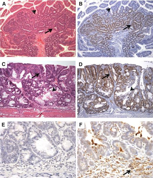 Figure 2. Id1 is overexpressed in mouse models of gastrointestinal neoplasia. A, intestinal adenomas that develop in ApcMin/+ mice consist of crowded neoplastic crypts with mucin depletion (arrow) compared with the background small bowel mucosa (arrowhead). B, these tumors show strong Id1 staining (arrow), whereas the nonneoplastic epithelium is negative (arrowhead). C, treatment with azoxymethane followed by several cycles of DSS produced colonic epithelial neoplasia (arrow) comingled with nonneoplastic epithelium (arrowhead). D, colitis-associated neoplasia shows strong, diffuse nuclear staining for Id1 (arrow) compared with entrapped nonneoplastic crypts (arrowhead). E, immunohistochemical stains for myeloperoxidase demonstrate a paucity of granulocytes in intestinal adenomas arising in ApcMin/+ mice, indicating that these lesions are not associated with inflammation. F, neoplasms associated with experimental colitis contain numerous inflammatory cells (arrow) that show strong staining for myeloperoxidase.