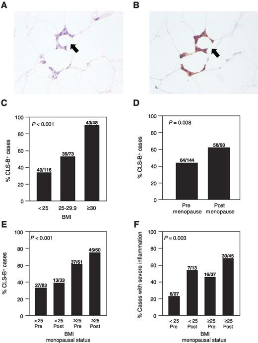 Figure 1. CLS-B are more common and more severe in obese and postmenopausal women. A, H&E-stained slide showing CLS-B (200×). B, immunohistochemical staining of CD68 of same lesion shown in A (200×). C, prevalence of CLS-B is higher in overweight and obese patients. D, prevalence of CLS-B is higher in postmenopausal women. E, overweight and obese postmenopausal women have the highest prevalence of CLS-B. F, overweight and obese postmenopausal women have the highest prevalence of severe breast WAT inflammation (CLS-B/cm2 > 0.38). Difference in prevalence of CLS-B (C, D, and E) or prevalence of severe breast WAT inflammation (F) across groups was assessed using the Fisher exact test.