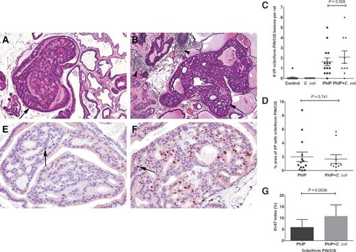 Figure 2. Development of prostatic cribriform PIN/CIS lesions in PhIP-treated animals. Examples of cribriform PIN/CIS lesions (arrows) in the ventral prostate (VP) lobe of PhIP (A) and PhIP + E. coli—treated animals (B). Note chronic inflammation (arrowheads) in PhIP + E. coli–treated animal. C, number of VP cribriform PIN/CIS lesions observed in study animals. D, size of cribriform PIN/CIS lesions as percent area of VP. Two H&E step sections were analyzed per animal and average values are reported. Representative images of Ki-67 IHC in the VP of PhIP (E) and PhIP + E. coli–treated animals (F) and Ki-67 index (G). Arrows indicate example Ki-67 positive cells.
