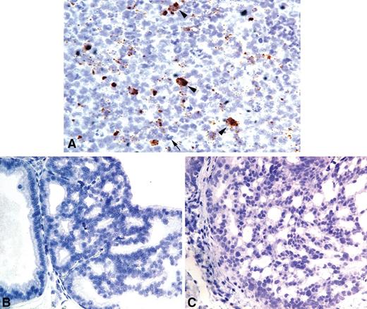 Figure 6. CISH analysis indicates that IL6 is not expressed locally in cribriform PIN/CIS lesions. IL6 expression in the rat ventral prostate was only observed in infiltrating immune cells (arrowheads) in areas of acute inflammation (as evidenced by the dense infiltration of neutrophils, arrow) in E. coli-alone–treated animals (A). IL6 was not observed by CISH in cribriform PIN/CIS lesions in either PhIP (B) or PhIP + E. coli–treated rats (C). Single spots in the nucleus likely represent the genomic copy of IL6.