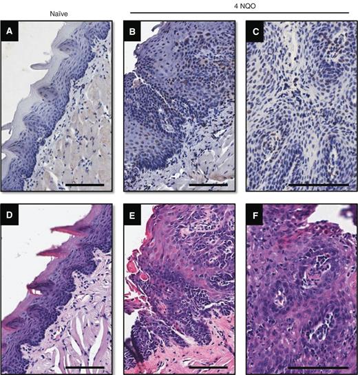 Figure 3. VDR expression in the 4NQO model. Immunostained sections of naïve (A) and 4NQO exposed tongues (B and C) at week 26 for the VDR. Corresponding H&E stained sections of the naïve tongue (D), 4NQO-treated tongue (E and F) are also shown. Magnification bars, 100 μm.
