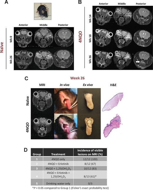 Figure 4. MRI of 4NQO-induced oral carcinogenesis in vivo. A, T2-weighted axial images of a naïve C57Bl/6 mouse at the beginning of the study, week 0, and at the end, week 26. Photograph of the mouse with the cross-sectional plane of the acquired MRI slices is also shown for orientation. B, T2-weighted axial images of a C57Bl/6 mouse at various time points following 14 weeks of exposure to the carcinogen, 4NQO. Arrow points to the location of the tumor and areas of thickening on the lateral borders of the tongue are outlined in white. C, T2-weighted axial MRI images of a naïve mouse and a 4NQO-treated mouse at week 26. Corresponding digital images of the tongue (in vivo and ex vivo) along with the histologic sections are shown. D, incidence of visible lesions on MRI in the 4NQO model following short-term treatment with erlotinib alone (25 mg/kg p.o, 5 days/week for 4 weeks) and in combination with 1,25(OH)2D3 (0.1 μg i.p, 3 days/week for 4 weeks). Animals were randomized into control or treatment arms following 14 weeks of exposure. MRI examination was performed at week 26 (8 weeks following completion of treatment).