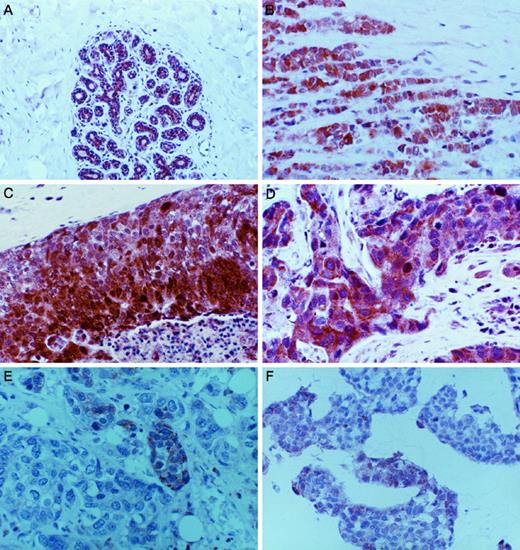 Fig. 1. Immunohistochemical detection of Fhit protein in sporadic breast cancer. A, normal breast (×200); B, section from lobular carcinoma case 574, scored Fhit +++ (×400); C, section from case 3472, a DCIS scored Fhit +++ (×400); D, section from case 18832, an IDC scored Fhit +++ (×400); E, case 1040, an IDC scored −/+ for Fhit (×400); F, case 3105, an IDC scored +/− for Fhit (×400).