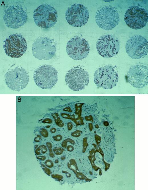 Fig. 2. Immunohistochemical detection of Fhit expression in micoarrayed Icelandic sporadic and familial breast cancers. A, section of slide showing numerous cases at low power (×25); B, an IDC scored Fhit +++ (×100).