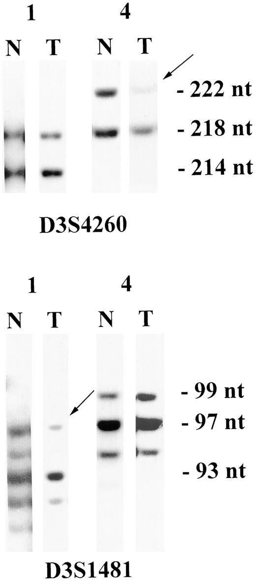 Fig. 3. LOH at the FHIT locus in matched normal (N) and tumor (T) tissue from cancer patients. Top, case numbers. Bottom, markers used. Right, size in nucleotides of the DNA products. Tumor 1 shows retention of both alleles with marker D3S4260 but loss with marker D3S1481, and tumor 4 shows retention with mrker D3S1481 and loss with marker D3S4260.