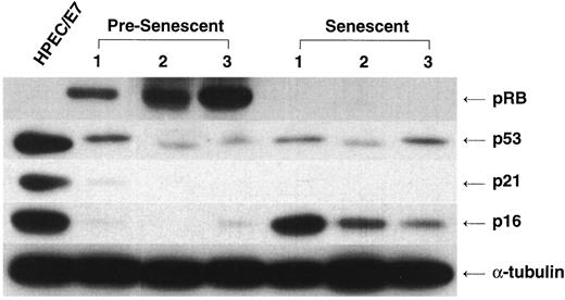 Fig. 2. Western analysis of p53, pRb, p16, and p21 in early- and late-passage, senescent normal prostate epithelial cells. Protein expression from three separate proliferating human prostate epithelial cell cultures is shown (Pre-Senescent, Lanes 1–3). These cells were continuously passaged and analyzed at passage 5 after growth arrest (Senescent, Lanes 1–3). Senescence was confirmed by positive SA-β-galactosidase staining (data not shown). p16 is strongly expressed in senescent cells compared to early-passage cells. In contrast, no alterations in expression are found in p53 or p21. Phosphorylated pRb levels are decreased at senescence. HPEC-E7 is used as a positive control because it strongly expresses p53, p21, and p16.