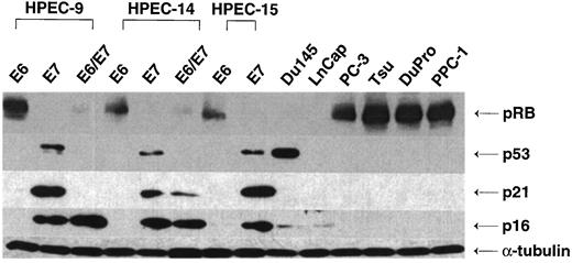 Fig. 5. Western analysis of p53, pRb, p16, and p21 in HPV16 E6-, E7-, or E6/E7-immortalized prostate epithelial cells and metastatic prostate cancer cell lines. Lanes 1–8 (from left to right), immortalized prostate epithelial cell lines generated by retroviral transfection of HPV16 E7 and/or E6 that inactivate pRb and p53, respectively. p16 expression is uniformly lost in HPV16 E6 cell lines in contrast to E7 cell lines. p16 is not detectable by increasing the length of exposure or protein levels. Immortalized prostate cancer cell lines (Lanes 9–14) from metastatic prostate cancers demonstrate an inverse correlation between p16 and pRb expression. p53 is wild type in cancer cell line LNCaP and shows detectable levels upon longer exposure.