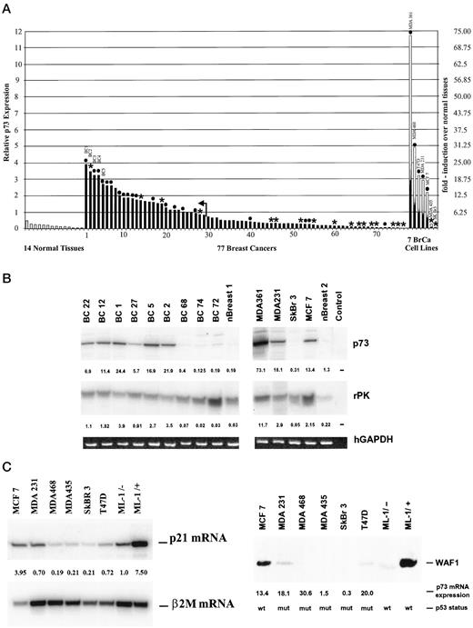 Fig. 1. p73 expression in primary breast cancers and breast cancer cell lines. A, histogram of relative expression of p73 transcripts, as determined by semiquantitative RT-PCR. Expression levels were standardized using the corresponding rPK value of each sample (left ordinate). The fold-induction over the mean normal tissue expression (0.16) is indicated (right ordinate). Arrow, the arbitrary cutoff for tumors with 5-fold or higher p73 expression compared with mean normal expression. Tumors with complex (•) or with simple (*) COOH-terminal splice variants are indicated. B, examples of breast cancers, normal breast tissue, and breast cancer cell lines are shown. Numbers on top indicate the -fold increase over the mean normal tissue expression, whereas numbers below refer to the -fold increase over the internal rPK standard. Control lane contains no template RNA. C, left, relative expression of p21WAF1 transcripts, as determined by semiquantitative RT-PCR. The numbers refer to the -fold increase over the internal β2 microglobulin standard (β2M); right, p21WAF1 immunoblot analysis of cell lysates (100 μg/lane) from breast cancer lines MCF-7, MDA 231, MDA 468, MDA 435, SkBr3, and T47D. Their respective fold-increases of p73 mRNA expression (over mean normal tissues) and p53 mutation status are indicated below. Cell lysates (100 μg) from ML-1 cells, either untreated (−) or treated (+) with the p53-activating agent camptothecin (5 μm for 24 h), serve as control for p21 induction.