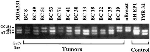 Fig. 2. Frequent biallelic expression of the p73 gene in breast cancer. Allele-specific p73 expression was determined in heterozygous samples by the StyI restriction length polymorphism of exon 2, which distinguishes the G/C (284 bp) and the A/T (234 bp) alleles. The 259-bp band is constant. Controls are the A/T homozygous IMR 32 and heterozygous SH EP1 neuroblastoma lines.