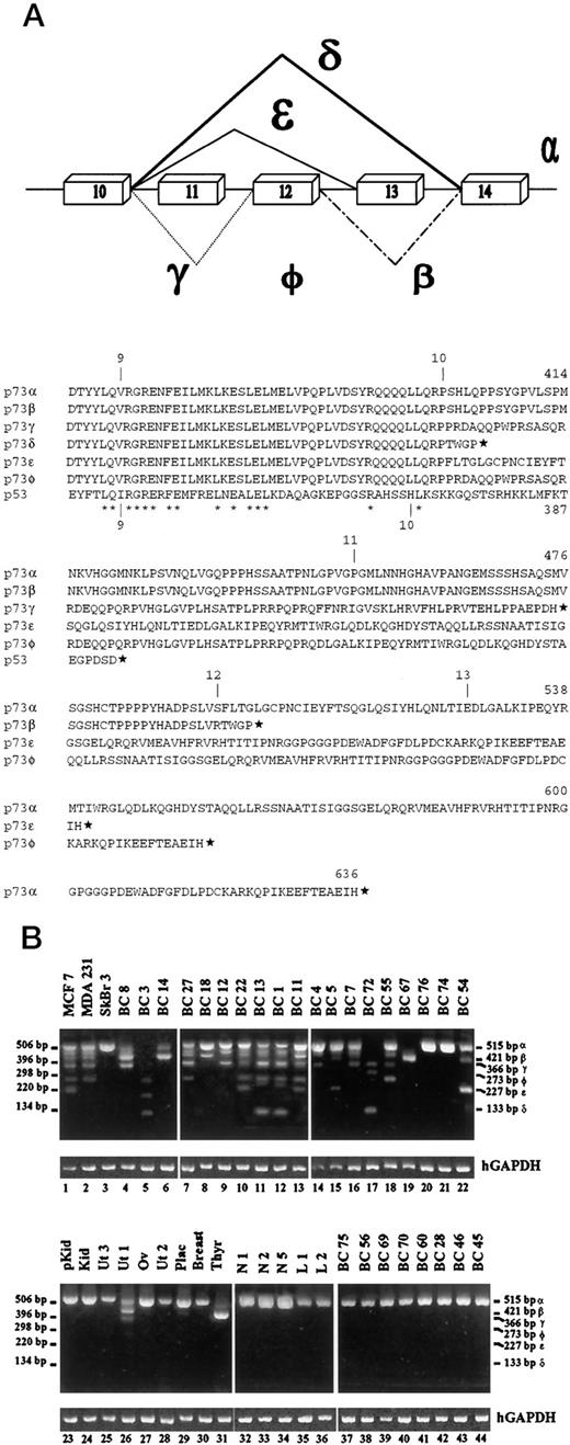Fig. 3. p73 COOH-terminal splice variants of the p73 gene. A, diagram of the six different COOH-terminal splice variants α, β, γ, δ, ε, and φ of the human p73 gene, detected in various normal and malignant tissues including breast cancer, as reported here. The spliced exons (top) and the predicted truncations or frameshifts of the amino acid sequence (bottom) are shown. B, samples of expression profiles among primary breast cancers and breast cancer cell lines and normal tissues. Generally, the low-expressing tissues express predominantly p73 α (bottom), whereas overexpressing tumors show a complex pattern (top). Length of the nested PCR product used to identify each variant is indicated.