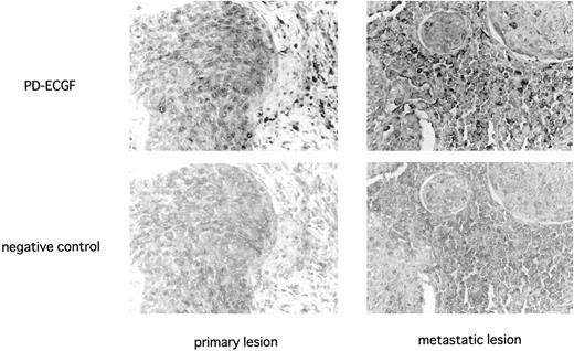 Fig. 2. Immunohistochemical staining for PD-ECGF in primary and metastatic lymph node lesions of uterine cervical cancers. A case of large cell nonkeratinizing squamous cell carcinoma of the uterine cervix, metastatic lesion in cardinal lymph nodes. The addition of the first antibody—mouse antihuman PD-ECGF antigen 654-1 or rabbit anti-factor VIII-related antigen—was omitted in the protocols for negative controls of PD-ECGF or factor VIII-related antigen, respectively. ×200.