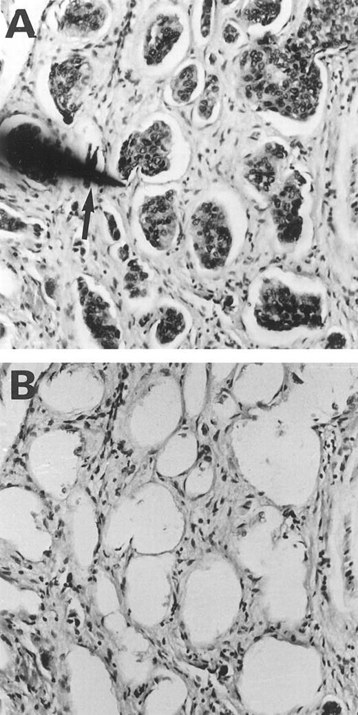 Fig. 1. Microdissection of the transitional cell carcinoma of urinary bladder. A, malignant transitional cells are arranged in irregularly shaped nests in the bladder tissue. The needle tip (arrow) is attached to a tumor cell nest. B, tumor cell nests were dissected, leaving large holes behind. ×100.